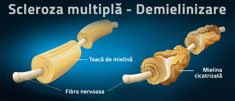 demielinizare