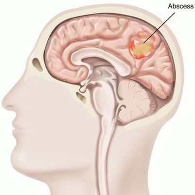 absces