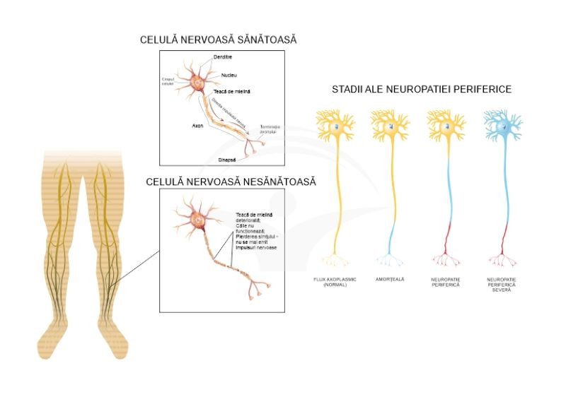 neuropatieperiferica