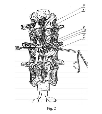 hernia disc 2