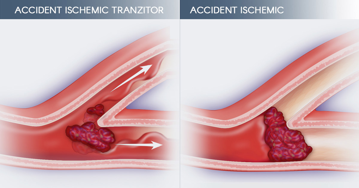 accident ischemic